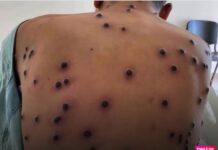 MPOX: Rondônia confirma quatro casos de doença transmissível e autoridades de Saúde de Vilhena orientam população